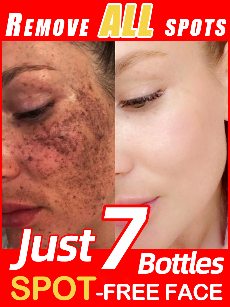 Luxury Skincare Essence - Ilumina las pecas Melasma, las manchas